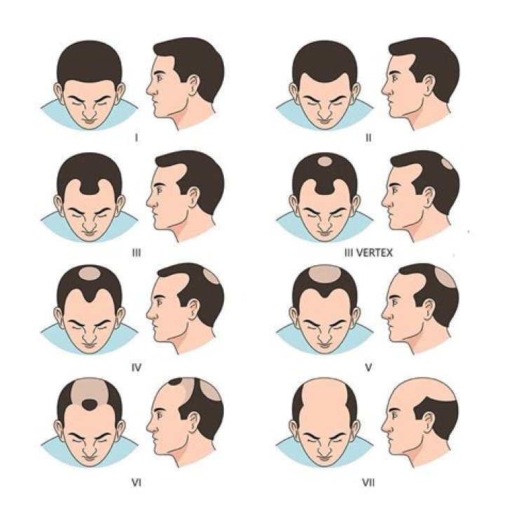 
Does Karl Kennedy Have Cancer? Neigbours Character Hair Loss And Baldness Reasons Explained 