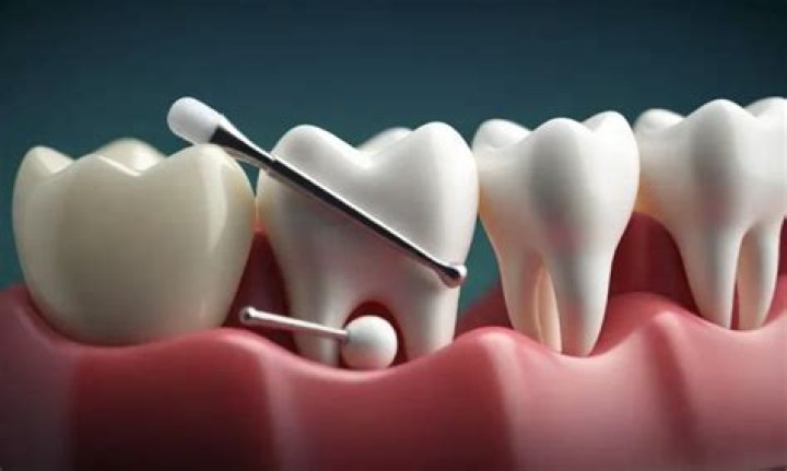 How to remove tooth gem