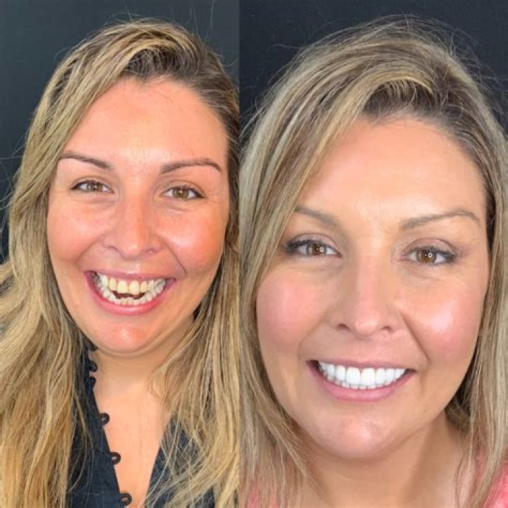 Matt Rife Teeth Before and After Veneers Photos Are Adorable