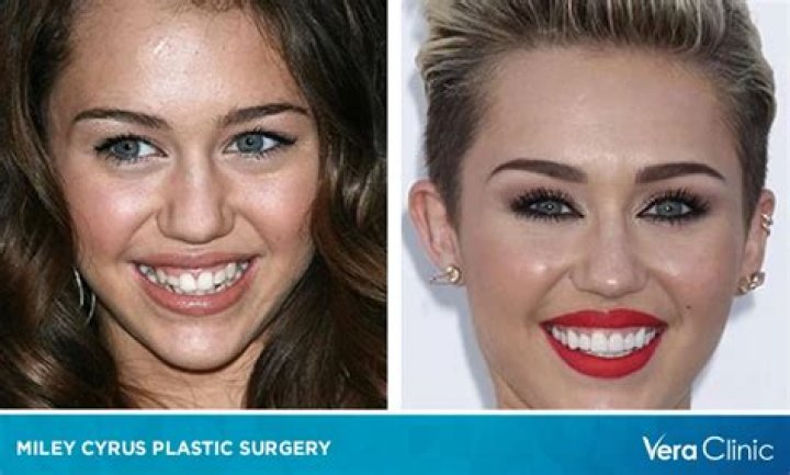 Miley Cyrus’ Plastic Surgery: The Singer Looks Different with a New Face; Speculations of Veneers, Nose Job, Buccal Fat Removal and More!