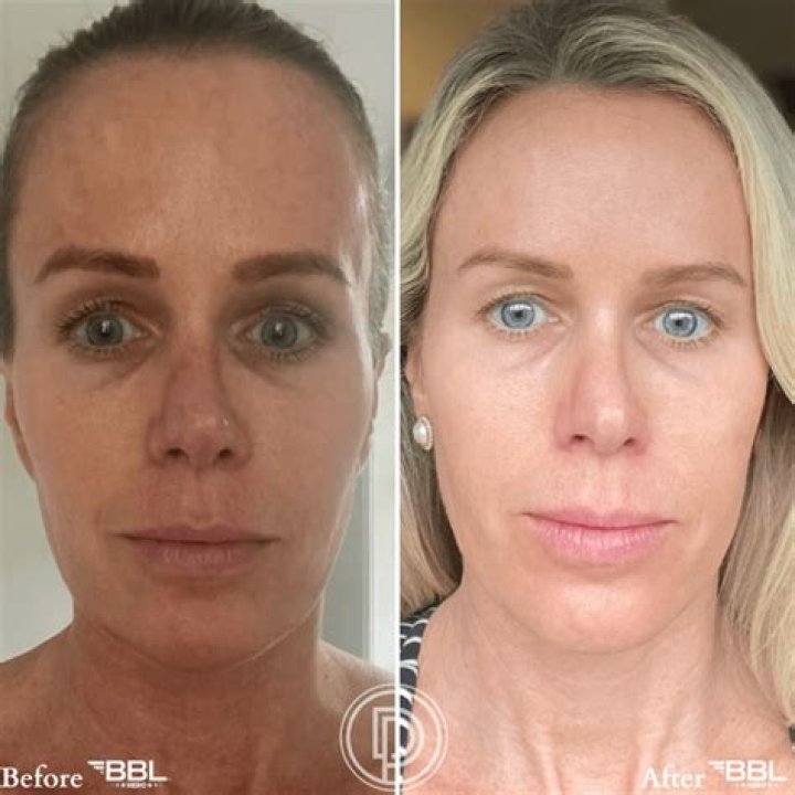 Rollie BBL Before And After Photo: Surgery Update 2023
