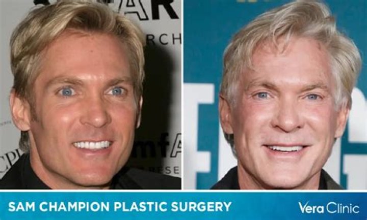 Sam Champion’s Plastic Surgery: How Many Cosmetic Treatments Has He Had?