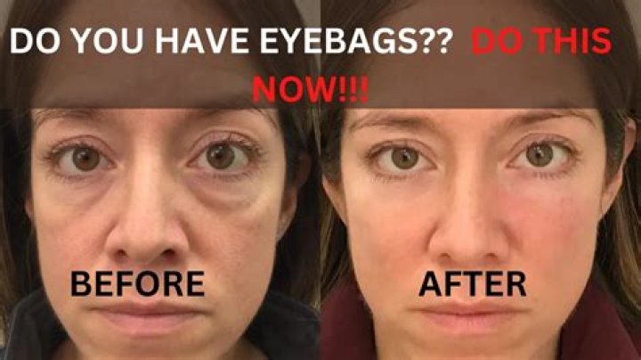 What Happened to Jason Genao Eyes? Eye Bags Condition Explained